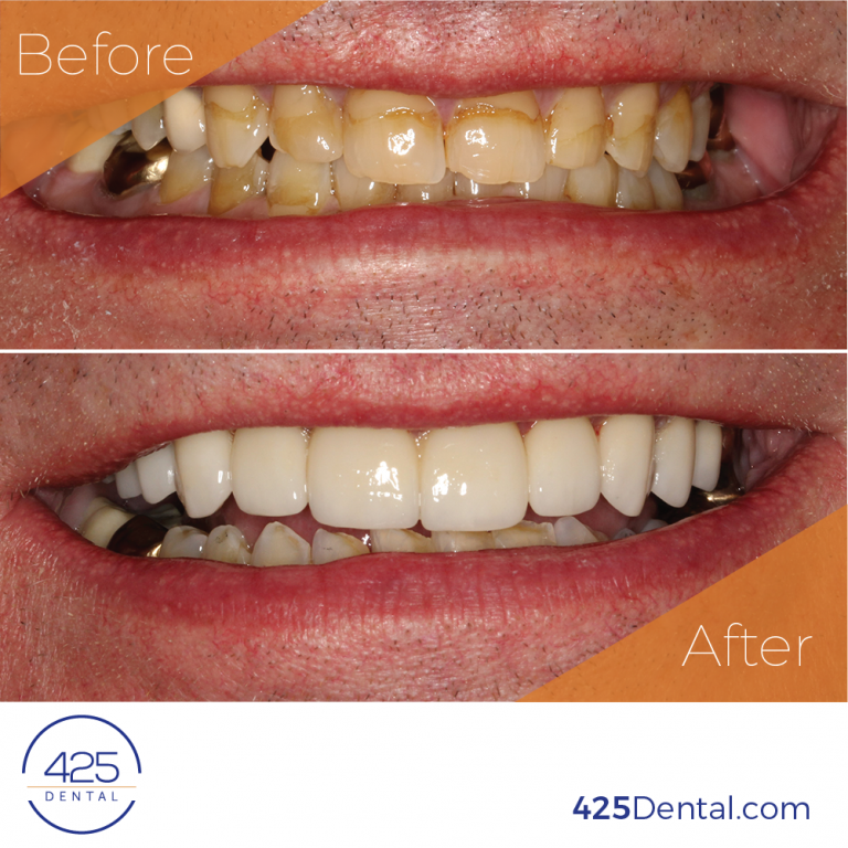 Before and After • 425 Dental