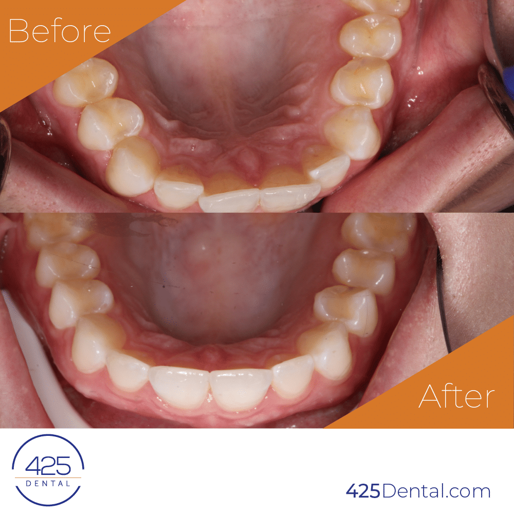 Gaia-425-Dental-Before-After-2_425-Dental-Elsa-W-Insta-1-1-1